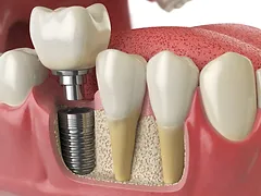 Implante Dentário em Guarulhos